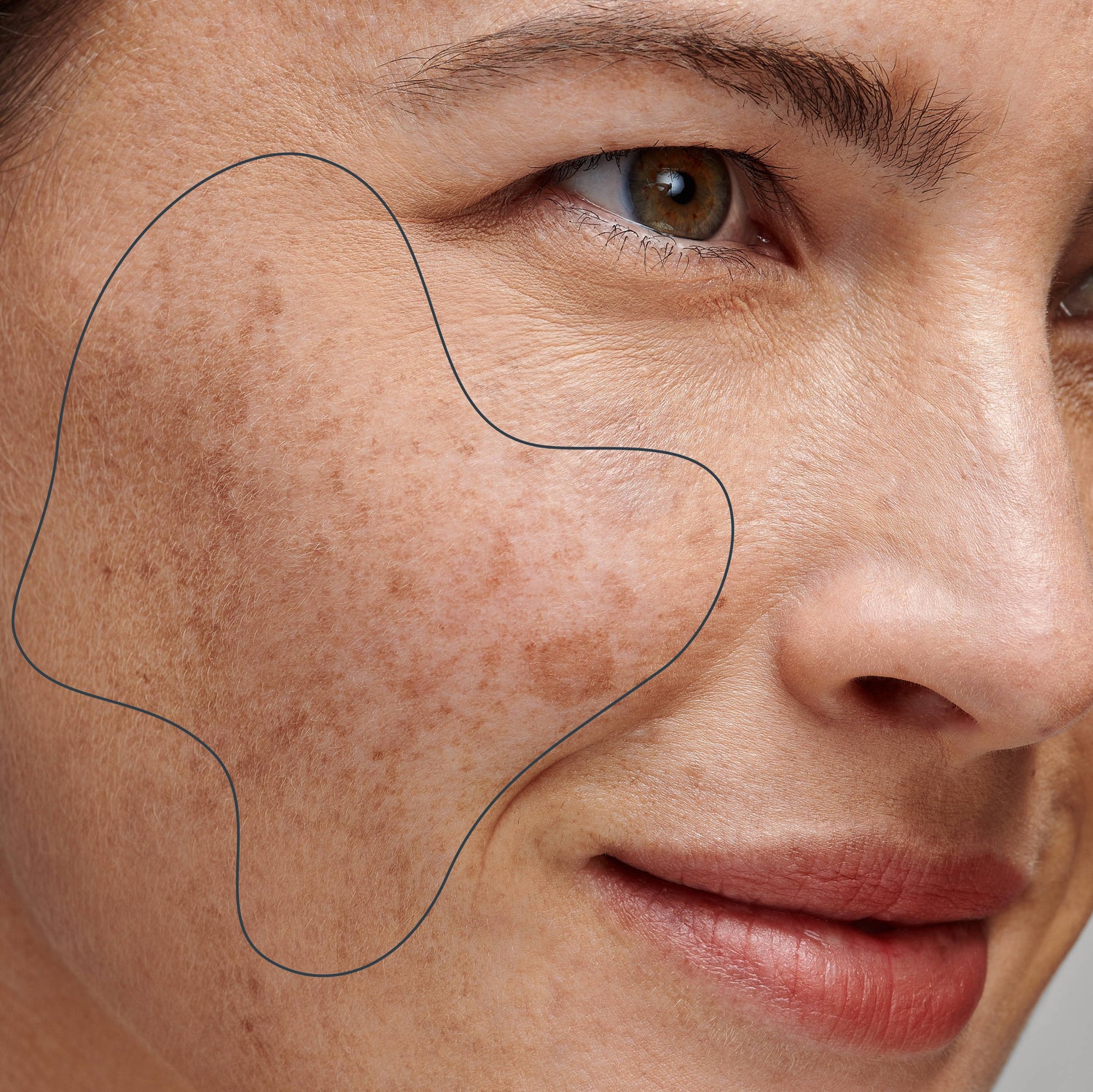 Best Pigmentation Treatment In Vijayawada