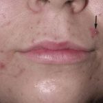 Acne Treatment Services in Vijayawada