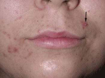 Acne Treatment Services in Vijayawada