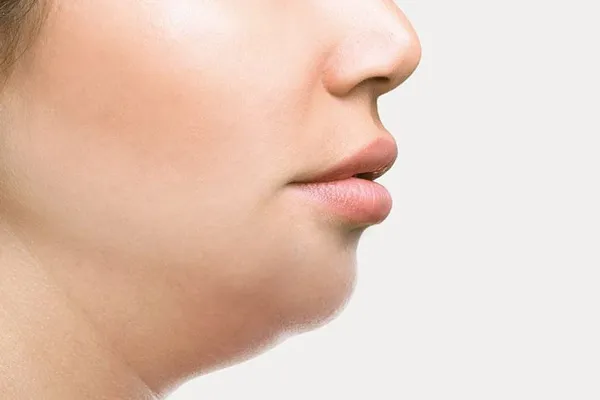 Double Chin Treatment in Vijayawada