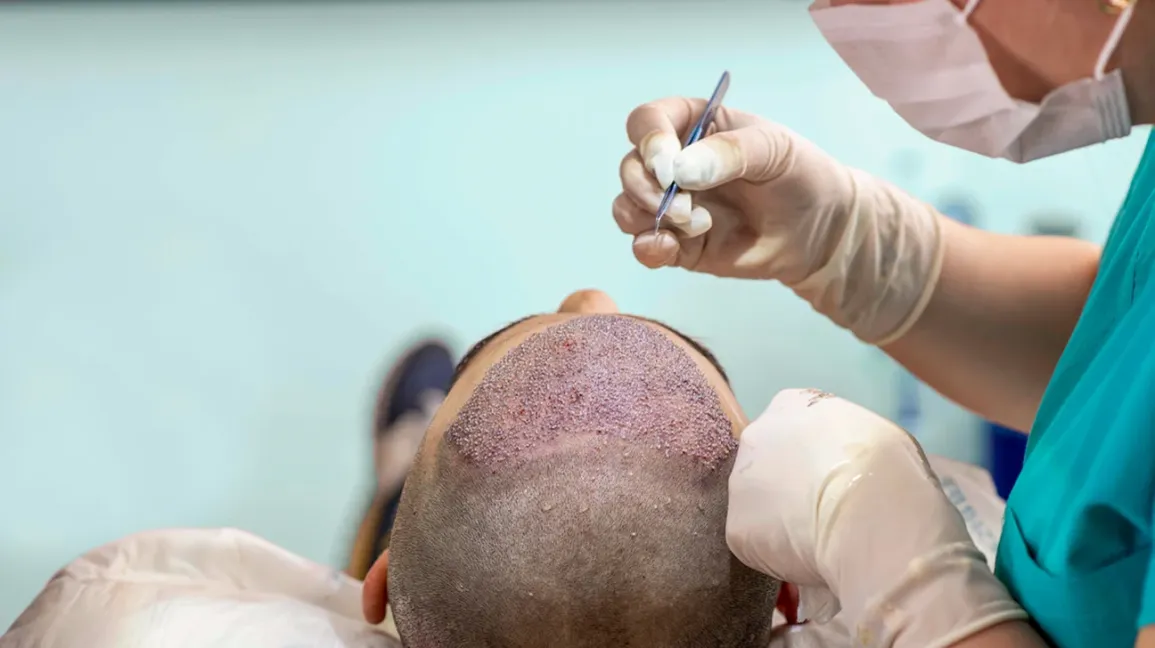 Best Hair Transplant in Vijayawada