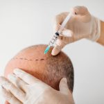 Best Hair Transplant Clinic in Vijayawada