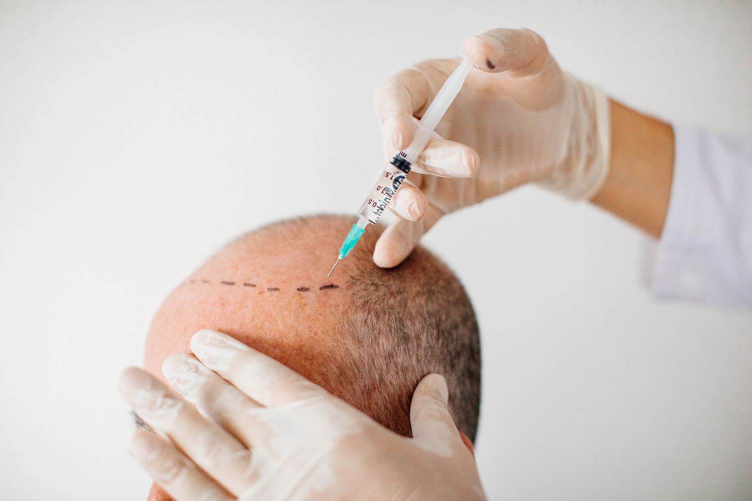 Best Hair Transplant Clinic in Vijayawada