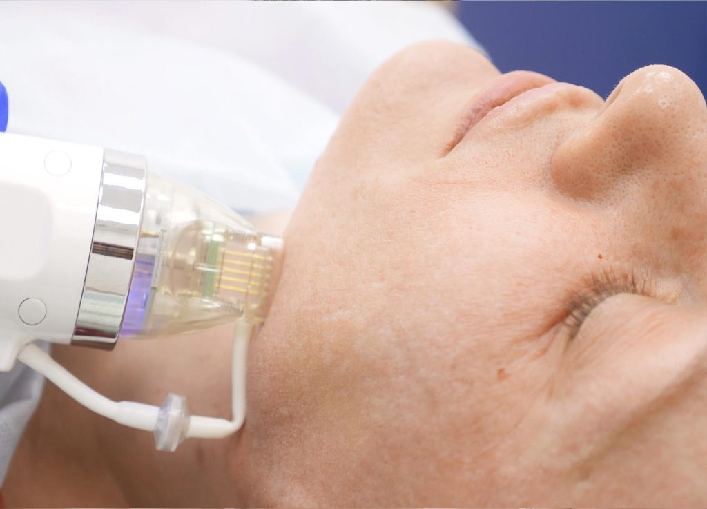 Best Micro Needling Treatment in Vijayawada