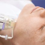 Best Micro Needling Treatment in Vijayawada