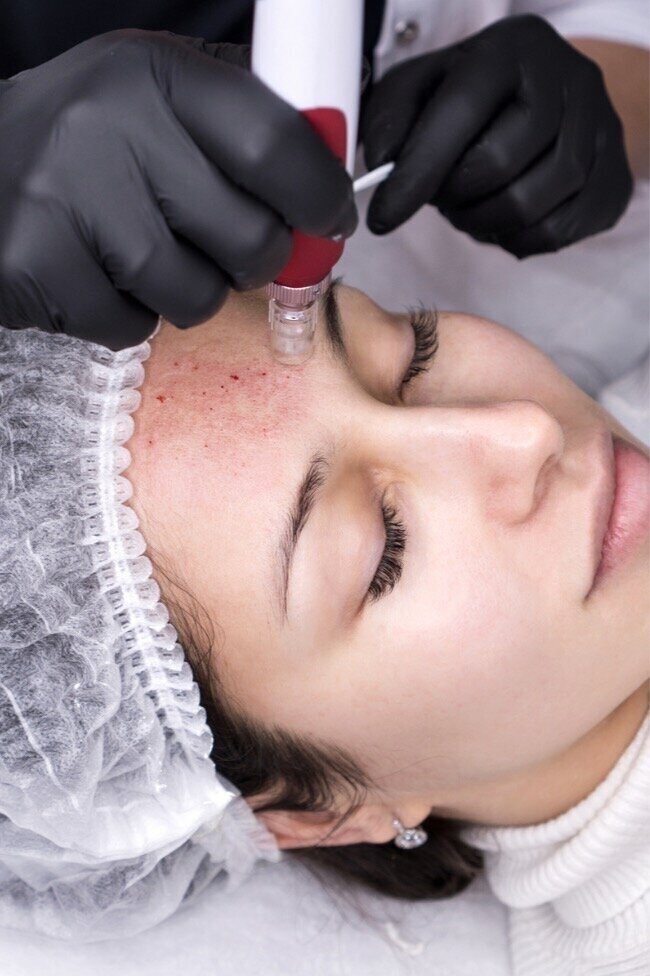 Micro Needling treatment cost in Vijayawada
