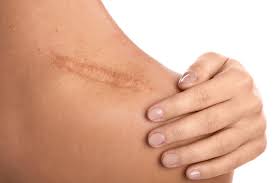 Scar Removal Treatment in Vijayawada
