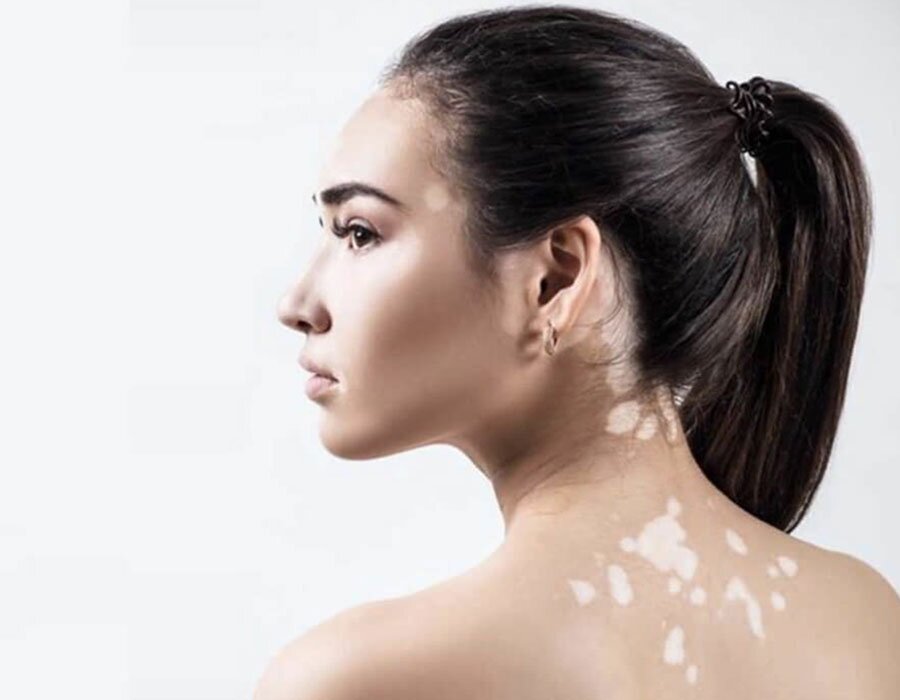 Best Vitiligo Treatment in Vijayawada