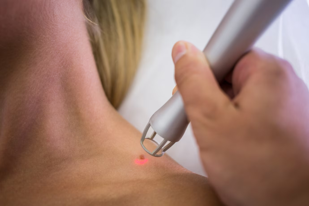 Best Skin Tag Removal Doctor In Vijayawada