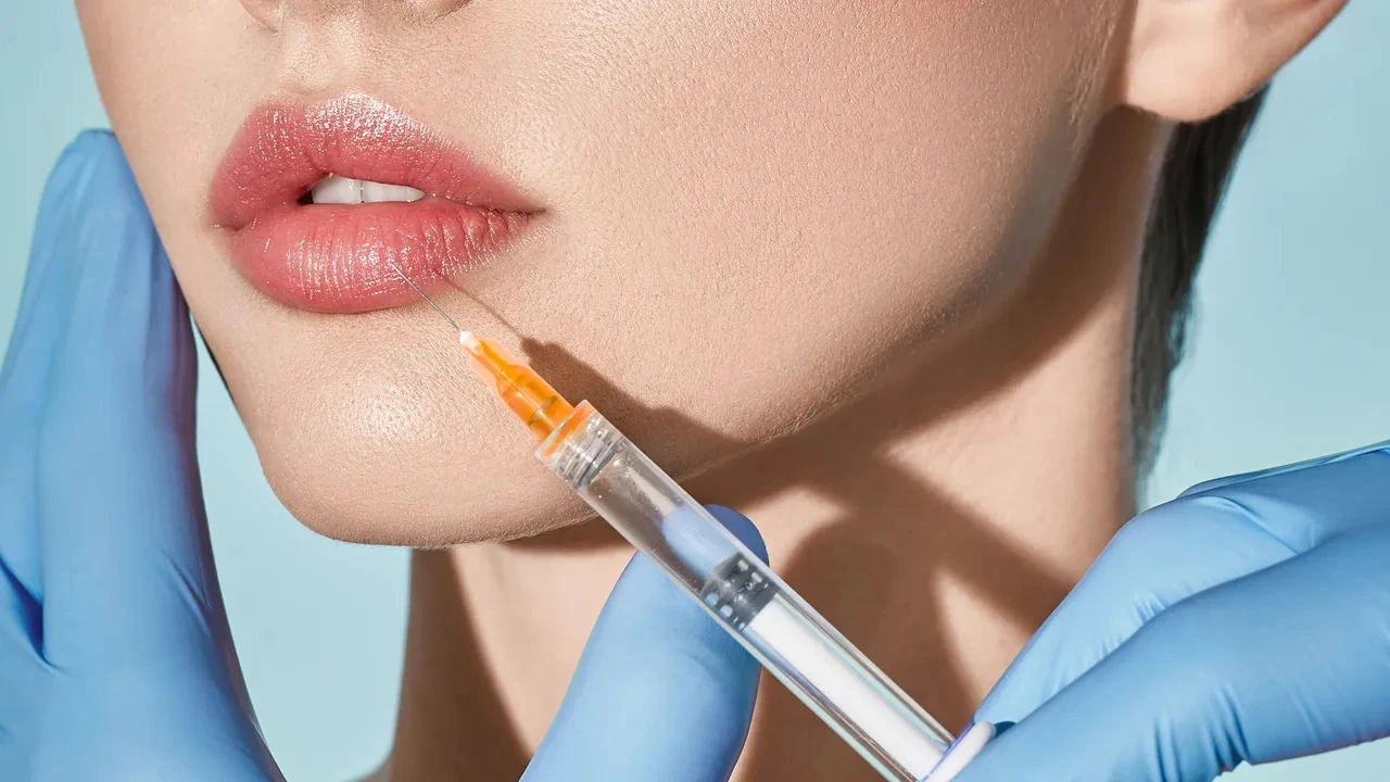 Derma lip filler